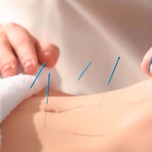 Acupuntura
